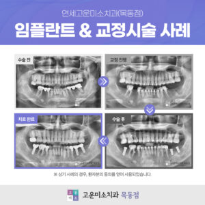 24.06.21_연세고운미소치과(목동점)_증례_임플란트&교정-함께한-사례