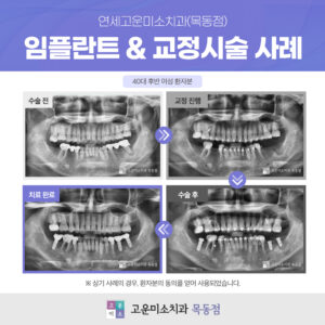 24.09.24_연세고운미소치과(목동점)_온라인_브릿지 제거&임플란트+교정 사례