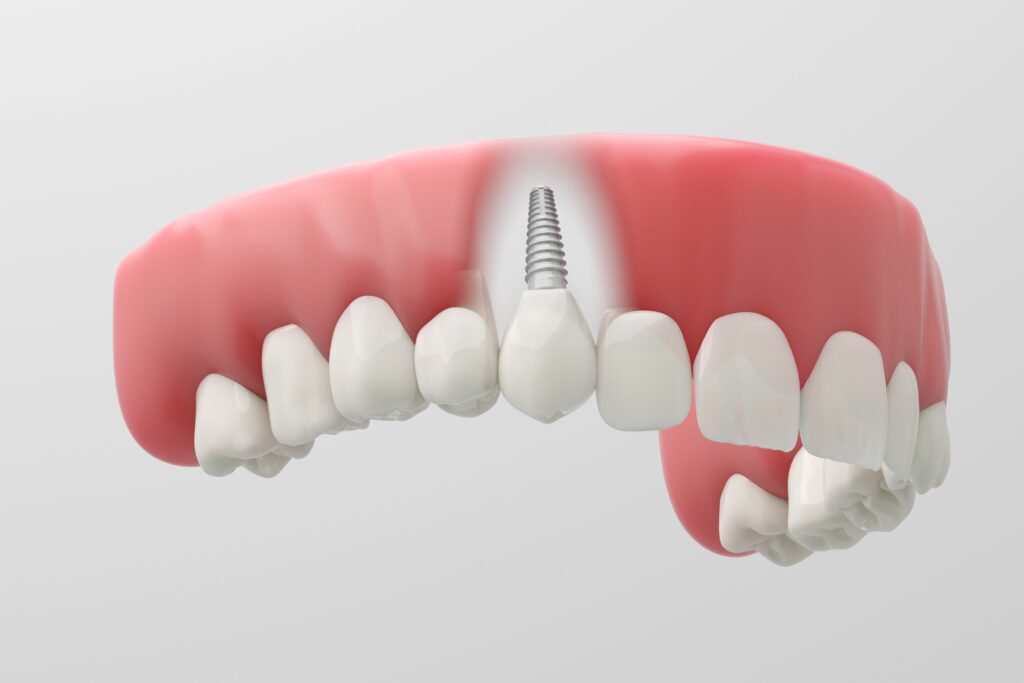 목동임플란트 충분한 골량 확보 중요
