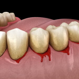 Bleeding,Gums,Or,Periodontal,-,Pathological,Inflammatory,Condition,Of,The