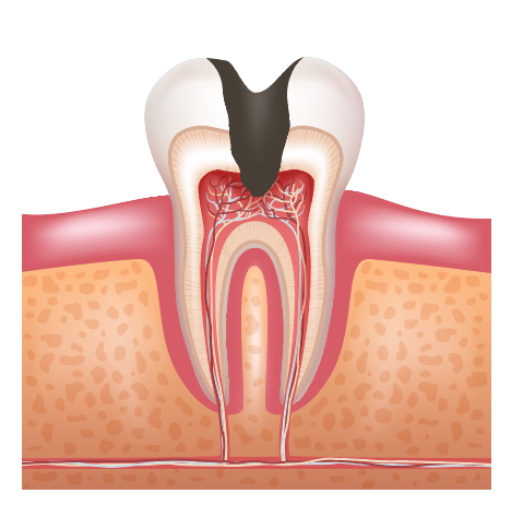 신경치료치수염