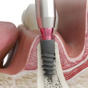 목동치과 임플란트