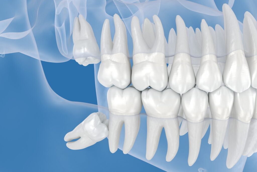 목동치과 사랑니