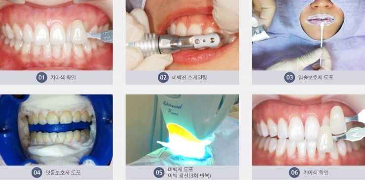 오목교역치과 치아미백
