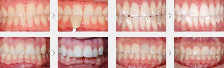 오목교역치과 치아미백