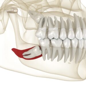 목동치과 사랑니