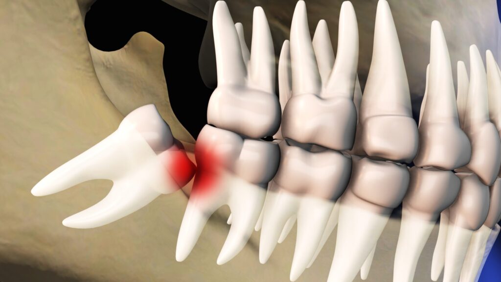 목동치과 사랑니
