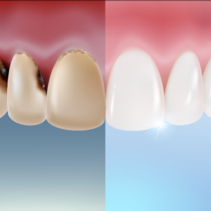 오목교역치과 치아미백