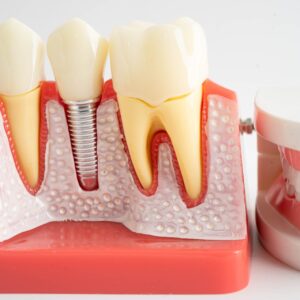 목동치과 임플란트