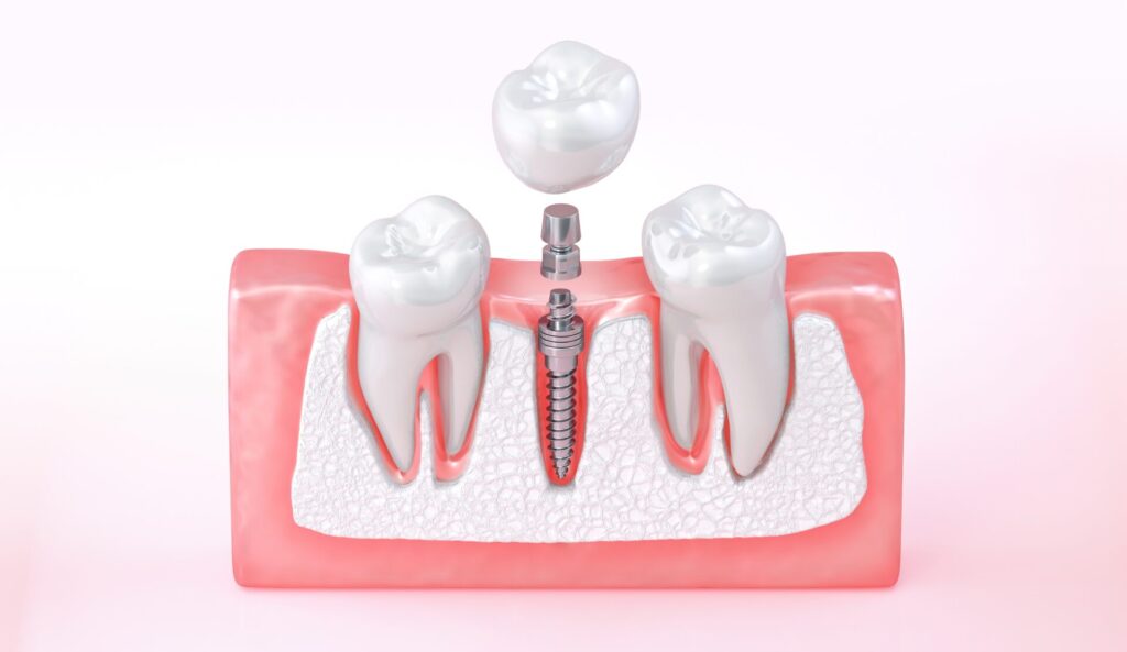 목동치과 임플란트