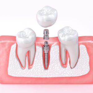 목동치과 임플란트