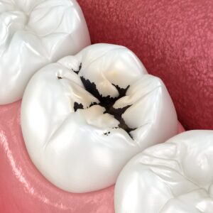 목동치과 충치치료