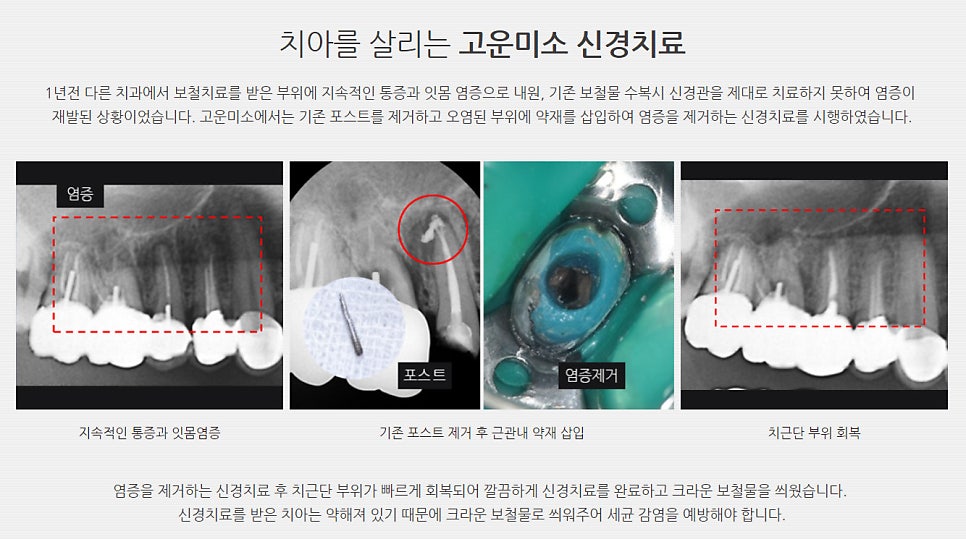 오목교역치과 초기 충치 발견 시 신경 손상 전 빠른 개선과 관리 방법이 중요한 이유